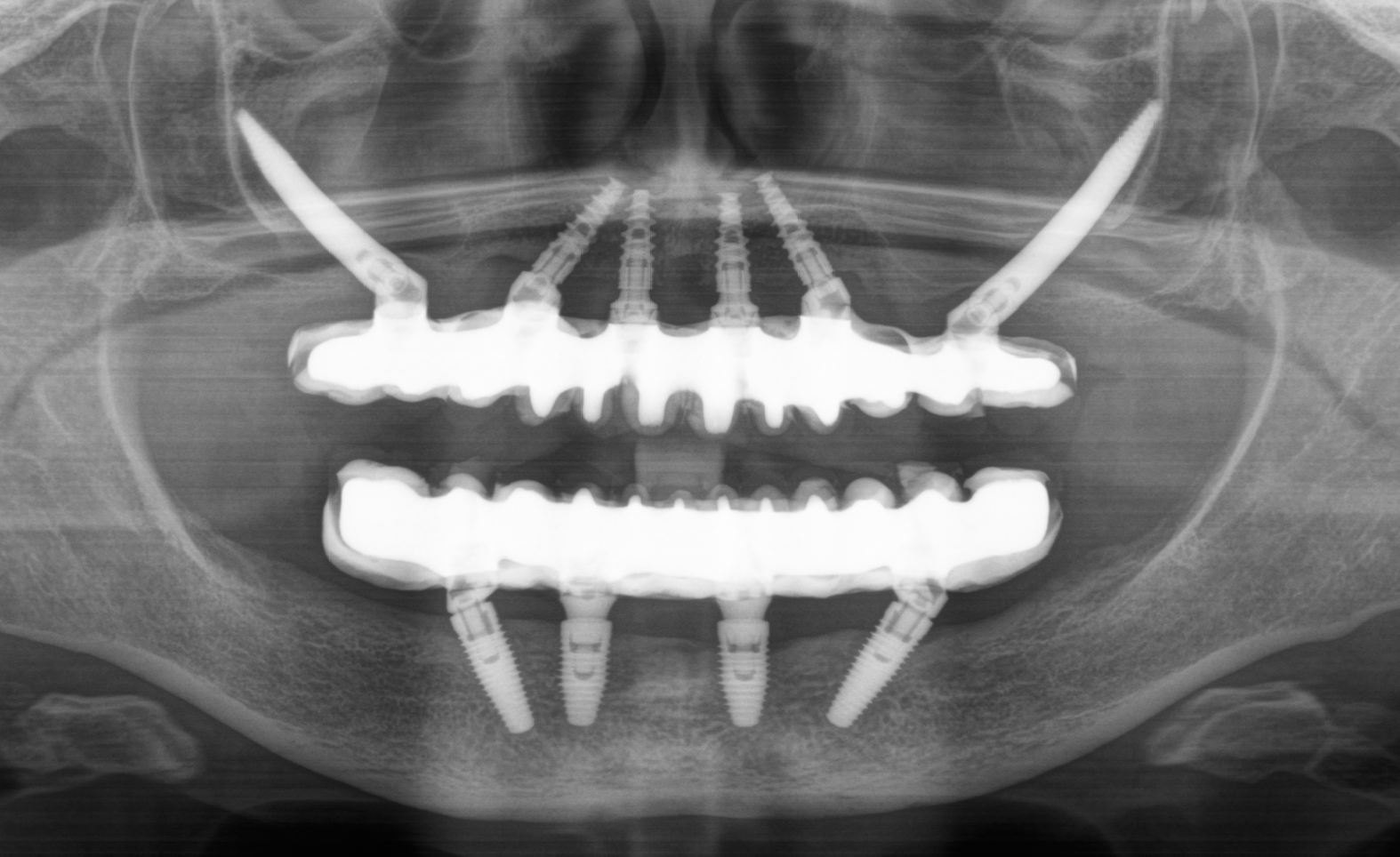 Panoramska snimka nakon terapije: fiksni most na implantatima u obje čeljusti